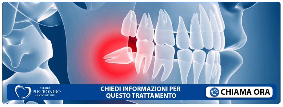trattamento-denti-inclusi Roma